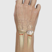 Wrist Open Reduction Internal Fixation